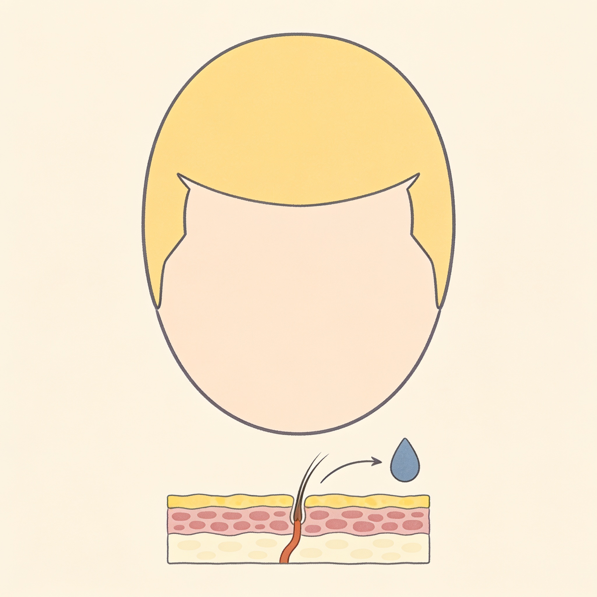Illustratie van een hoofd van bovenaf met inhammen bij de slapen en daaronder een strookje doorsnede van de hoofdhuid met een haarwortel en een druppel